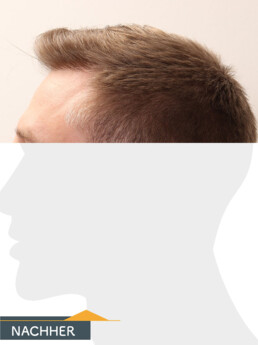 Herr S. Z. - Beispiel Stirnhaargrenze nach der Behandlung