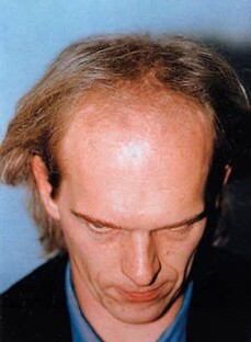 Patient Peter Thurnhart zeigt seine Stirnglatze 1997 vor seiner ersten Haartransplantation bei Moser Medical
