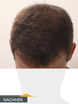 Herr K. W. - Beispiel Stirnhaargrenze nach der Behandlung