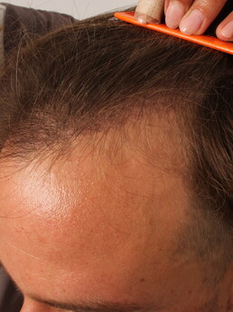 6 Tage nach der FUE-Haartransplantation