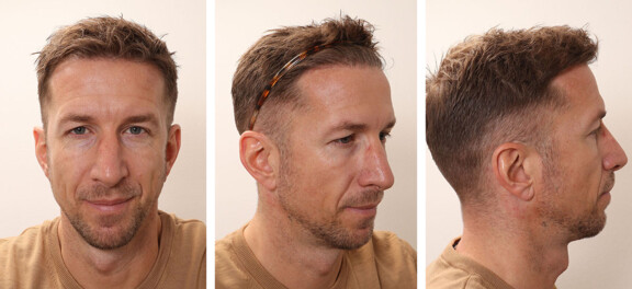 6 Monate nach der Haartransplantation