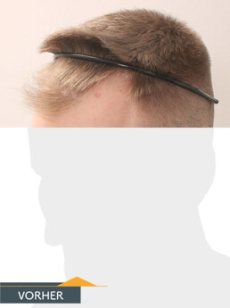 Herr S. Z. - Beispiel Stirnhaargrenze vor der Behandlung