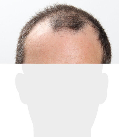 Herr W. K. - Beispiel Stirnhaargrenze vor der Behandlung