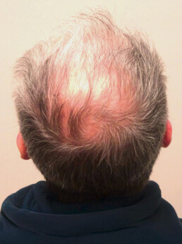 Herr U.J.  vor der Behandlung