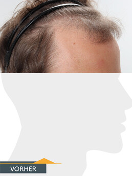 Herr Z. V. - Beispiel Stirnhaargrenze vor der Behandlung