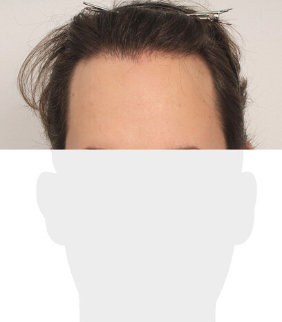 Herr N. D. - Beispiel Stirnhaargrenze vor der Behandlung