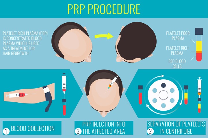 Prozess der PRP Therapie von Moser, welche bei Haarausfall verwendet wird