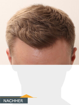 Herr S. Z. - Beispiel Stirnhaargrenze nach der Behandlung