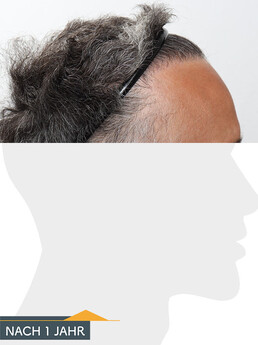 Herr F. S. - Beispiel Stirnhaargrenze nach der Behandlung