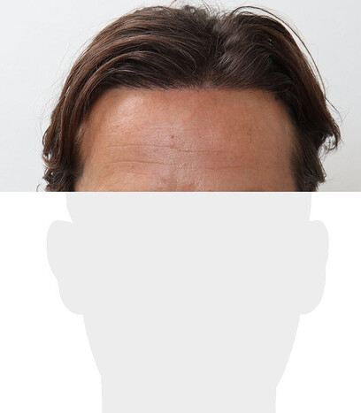 Herr S. E.  - Beispiel Stirnhaargrenze nach der Behandlung