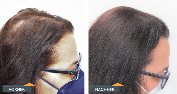 Mikro-Haarpigmentierung Vorher-Nachher-Vergleich bei einer Frau