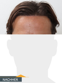 Herr S. E.  - Beispiel Stirnhaargrenze nach der Behandlung