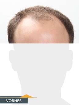 Herr C. P. - Beispiel Stirnhaargrenze vor der Behandlung