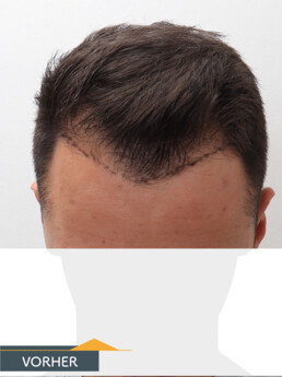 Herr P. O. - Beispiel Stirnhaargrenze vor der Behandlung