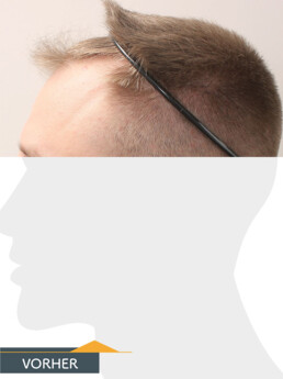 Herr S. Z. - Beispiel Stirnhaargrenze vor der Behandlung