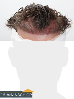 Herr K. G. - Beispiel Stirnhaargrenze vor der Behandlung