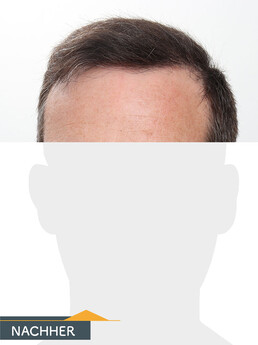 Herr W. K. - Beispiel Stirnhaargrenze nach der Behandlung