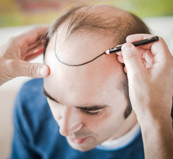 Haartransplantation: Einzeichnen der späteren Haarlinie bei einem Patienten