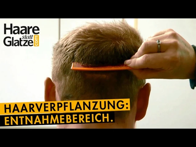 Spenderbereich einer FUT-Haatransplantation - Detailansicht