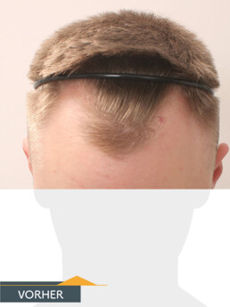 Herr S. Z. - Beispiel Stirnhaargrenze vor der Behandlung