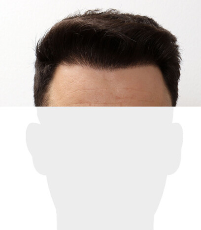 Herr P. O. - Beispiel Geheimratsecken nach der Behandlung