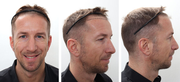 3 Monate nach der Haartransplantation
