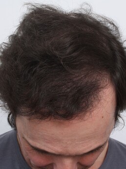 9 Monate nach der Haartransplantation