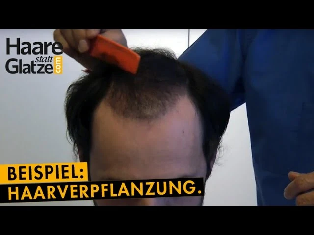 5 Monate nach Haartransplantation bei Moser Medical - Zwischenergebnis