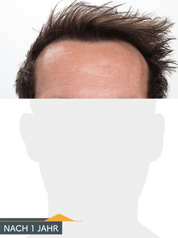 Herr U. D. - Beispiel Stirnhaargrenze nach der Behandlung