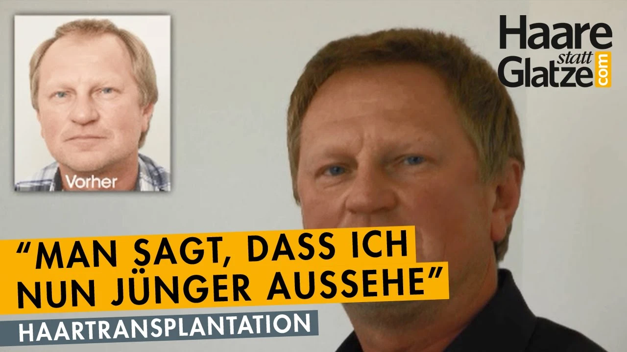Michael V.: Haartransplantation bei Geheimratsecken