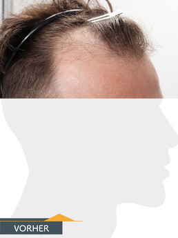 Herr V. O. - Beispiel Stirnhaargrenze vor der Behandlung