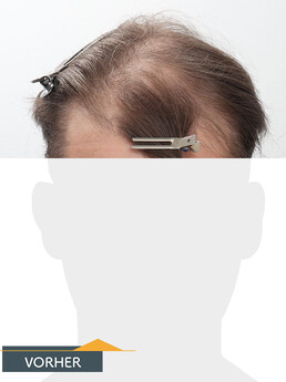 Herr P. A. - Beispiel Stirnhaargrenze vor der Behandlung