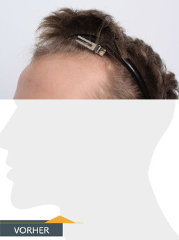 Herr K. G. - Beispiel Stirnhaargrenze vor der Behandlung