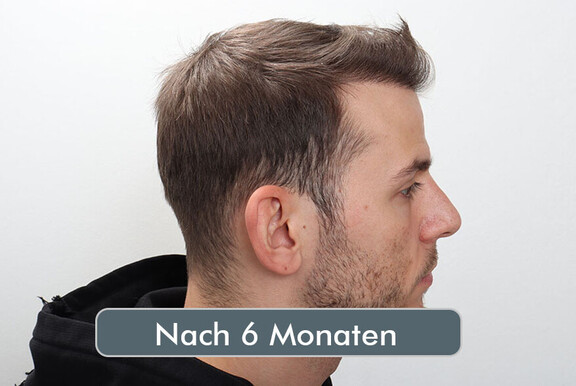 MaxaMillion vor der Haartransplantation bei Moser Medical