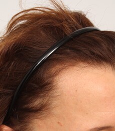 Patientin zeigt ihre Geheimratsecken vor der Haartransplantation bei Moser Medical