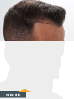 Herr P. O. - Beispiel Stirnhaargrenze vor der Behandlung