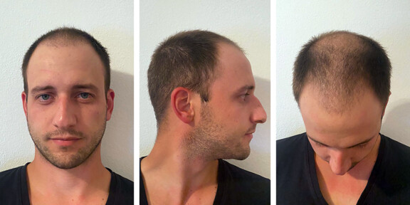 3 Monate nach der Haartransplantation