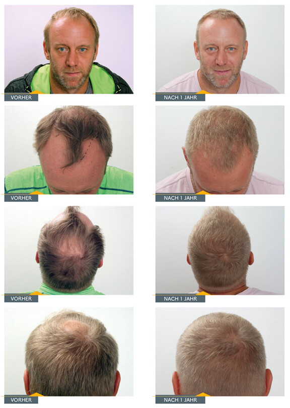 Stefan Koubek präsentiert sein Haar am Behandlungstag, 5 Monate nach der Haartransplantation und ein Jahr nach der Behandlung