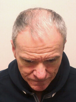 Herr U.J.  vor der Behandlung