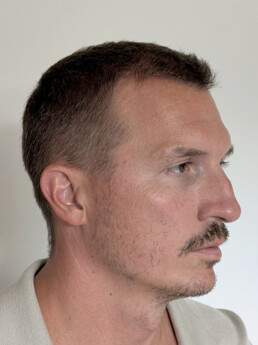 Rene Pranz nach der Behandlung