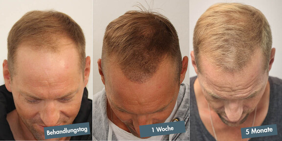 Alexander Horst präsentiert seine Haare am Behandlungstag, bei einem ersten Zwischenergebnis nach einer Woche und 5 Monate nach der Haartransplantation