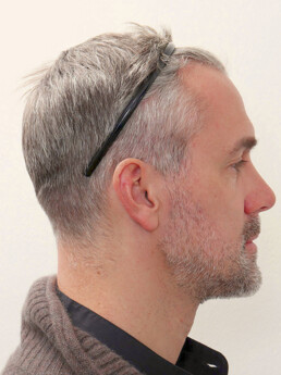 Stefan Maierhofer vor der Behandlung