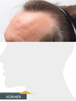 Herr U. D. - Beispiel Stirnhaargrenze vor der Behandlung