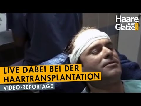 Manuel Horeth, DER MENTALIST: Live-Reportage seiner Haartransplantation