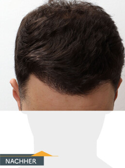 Herr P. O. - Beispiel Stirnhaargrenze nach der Behandlung