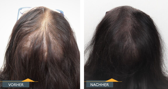 Mikro-Haarpigmentierung Vorher-Nachher-Vergleich bei einem Mann