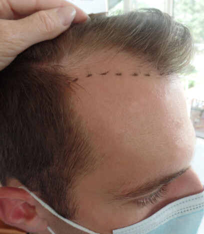 Patient Andreas vor der Haartransplantation bei Moser Medical