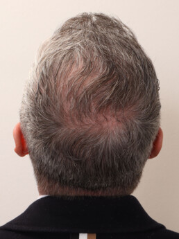 Herr U.J.  nach der Behandlung