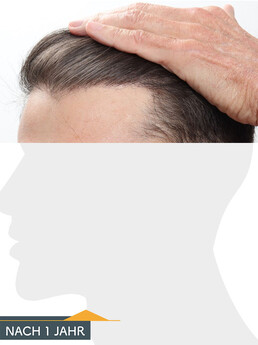 Herr P. A. - Beispiel Stirnhaargrenze nach der Behandlung