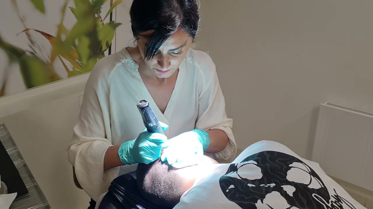 So funktioniert die Mikro-Haarpigmentierung "Haartattoo" - Beispielvideo von Moser Medical